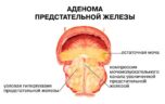Какие лекарства эффективны от аденомы простаты?