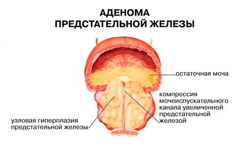 Какие лекарства эффективны от аденомы простаты?