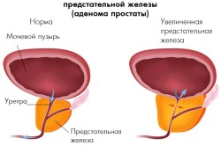 Схема доброкачественной гиперплазии простаты