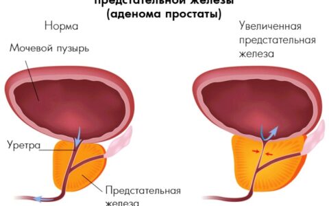 Что такое доброкачественная гиперплазия простаты и как ее лечить