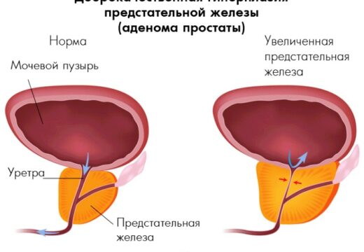 Что такое доброкачественная гиперплазия простаты и как ее лечить