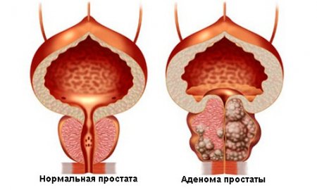 Отличие нормальной простаты от больной аденомой простаты Отличие нормальной простаты от больной аденомой простаты