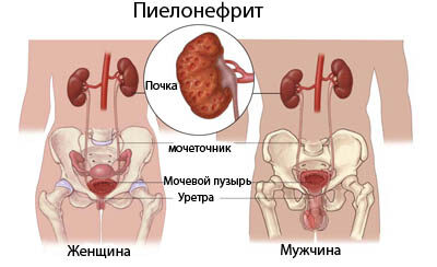 Лечение антибиотиками при пиелонефрите и цистите