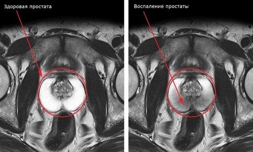 Как избавиться от боли при простатите у мужчин