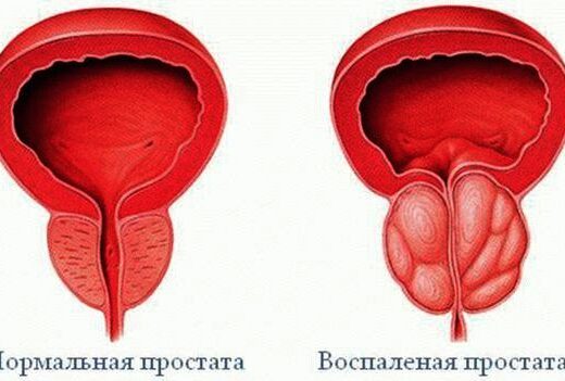 Можно ли полностью вылечить простатит?