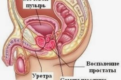 Схема простатита