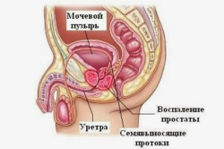Схема простатита