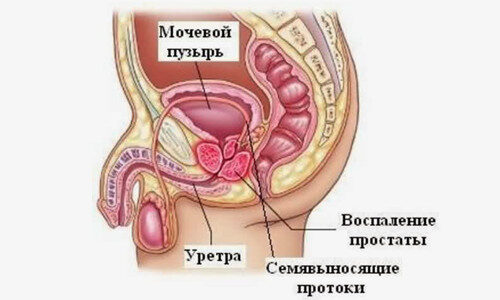 Лечение простатита гирудотерапией (пиявками)
