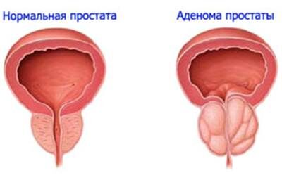 Лечение аденомы простаты при помощи операции