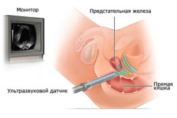 Схема УЗИ простаты