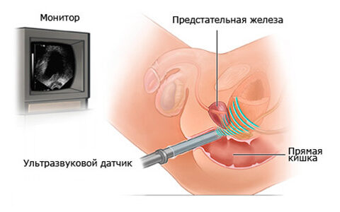 Что такое ТРУЗИ простаты и каковы показания к его проведению?