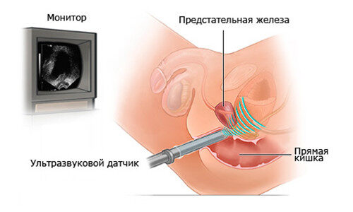 Что такое ТРУЗИ простаты и каковы показания к его проведению?