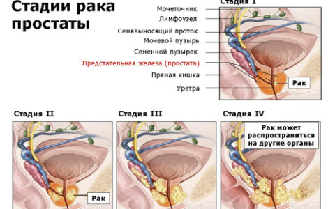 Рак простаты: основные симптомы и методы лечения