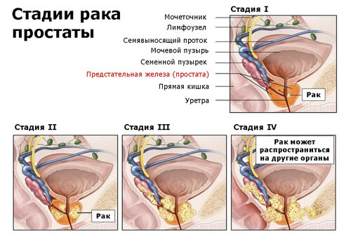 Рак простаты: основные симптомы и методы лечения