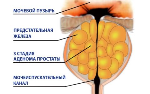 Заболевания в мужской урологии и их лечение