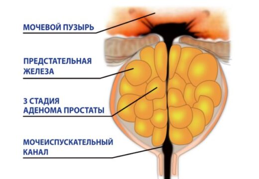 Заболевания в мужской урологии и их лечение