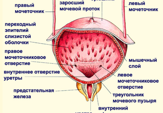 Что такое острый цистит?