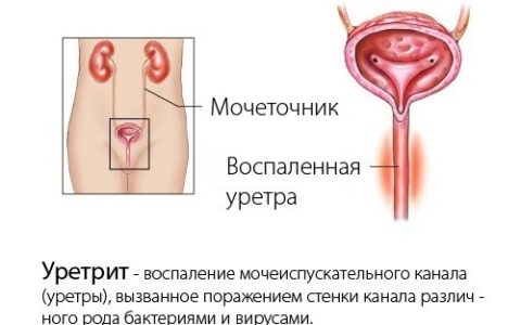 Какие заболевания урологические бывают и как их лечить?